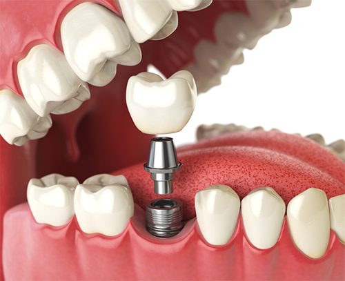 Dental implant in Kelowna