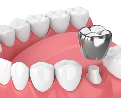 crown and bridge dental treatment in Kelowna