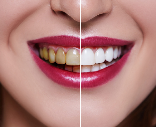 Teeth Whitening treatment