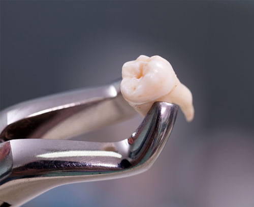 wisdom tooth extraction treatment near me
